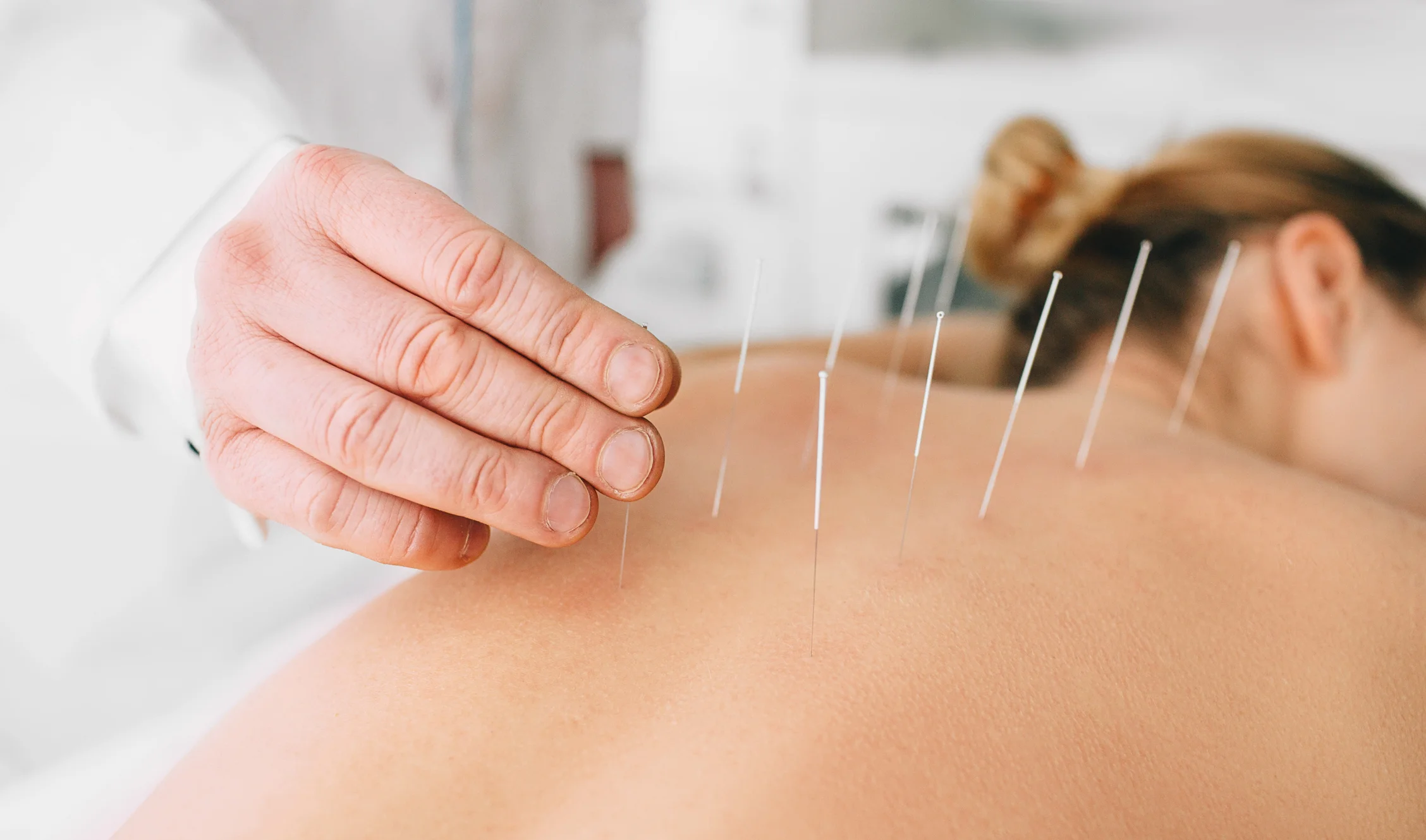 Acupuncture Mississauga - Body Kinetix Mississauga